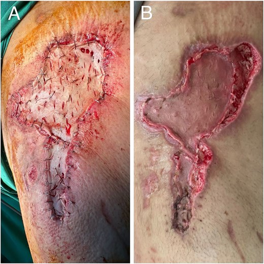 Images from case 2. (A) Intraoperative image showing split thickness grafting. (B) Postoperative partial graft necrosis.