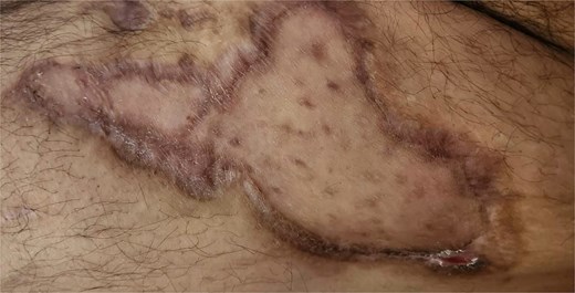 Image from case 2 showing full healing.