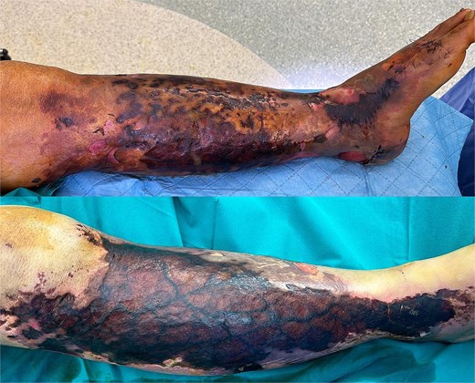Image of case 8—64 year old with bilateral necrosis.