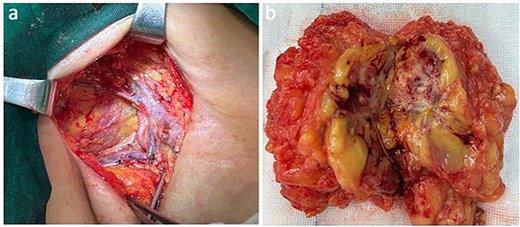 Presentation of the surgical image of tumor resection in the axillary region (a). Metastatic proximal-type ES presented as ill-defined multinodular masses in the muscle of the axillary region during intraoperative (b).