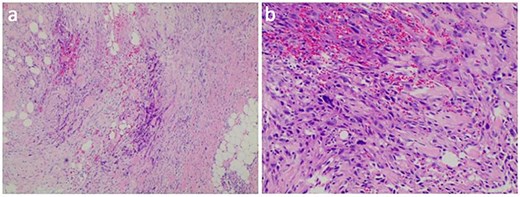 HE stained sections showed cellular tumor and local tumor necrosis (a); the epithelioid cells arranged in a cord shape, eosinophilic cytoplasm, and scattered rhabdoid cells (b).