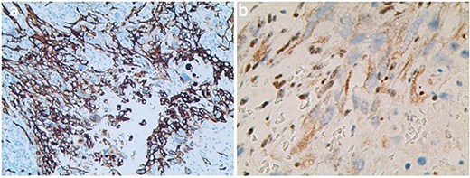 Immunohistochemical stained for CD34 (a) and INI1 (b).