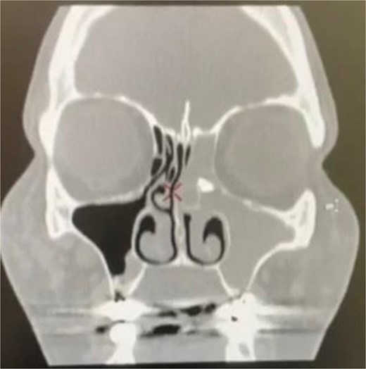 Coronal computed tomography image showing left maxillary and ethmoid sinusitis and a foreign body in the left anterior ethmoid sinus.