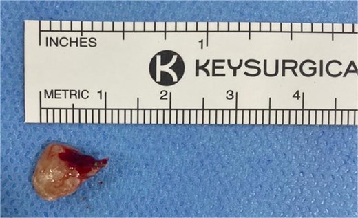 Tooth root extracted from the left anterior ethmoid sinus during endoscopic sinus surgery.