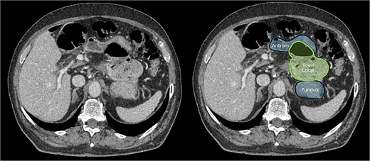 CT scan of the abdomen showing that the colon passing above and to the left of the lesser curvature of the stomach, implying that it had herniated through the foramen of Winslow and into the lesser sac.