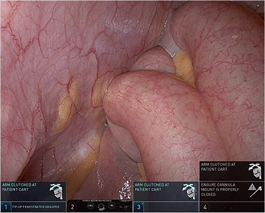 Dilated small bowel loops.