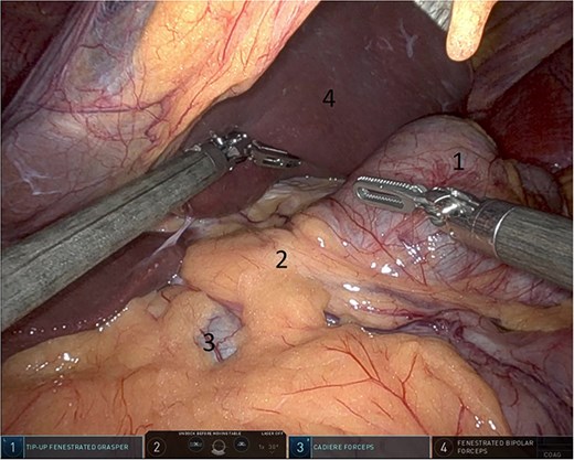 Herniated colon through the foramen of Winslow (1: incarcerated colon, 2: hepato-duodenal ligament, 3: herniating colon, 4: the liver).