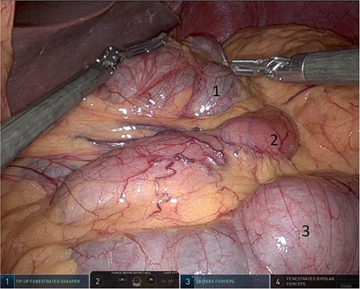 Pars flaccida covering the herniated bowel (1: pars flaccida over the herniated bowel, 2: the stomach, 3: transverse colon).