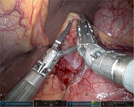 Dissection anterior to the hepatoduodenal ligament (1: portal vein, 2: foramen of Winslow, 3:first part of the duodenum).