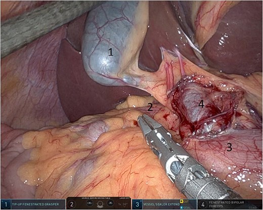 Gallbladder was retracted to the patient's right upper quadrant which allowed for the retraction of the foramen of Winslow and anterior mobilization of it (1: gall bladder, 2: herniating colon, 3: first part of the duodenum, 4: portal vein).