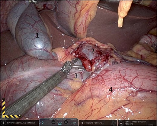 Elevating hepato-duodenal ligament structures to allow reduction of herniating colon (1: gall bladder, 2: portal vein, 3: herniating colon, 4: first part of the duodenum).