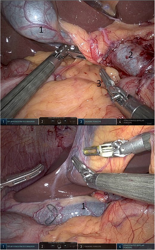 Omentum was placed into the defect (above) and gall bladder fell into the defect (below) (1: gall bladder, 2: portal vein, 3: omentum).