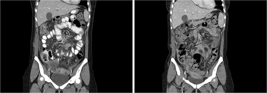Coronal CT abdomen from admission 3 (left) and admission 4 (right). Heterogenous collection in right pouch of Douglas, progression of mesenteric/omental fat stranding, thickened loops of small bowel.