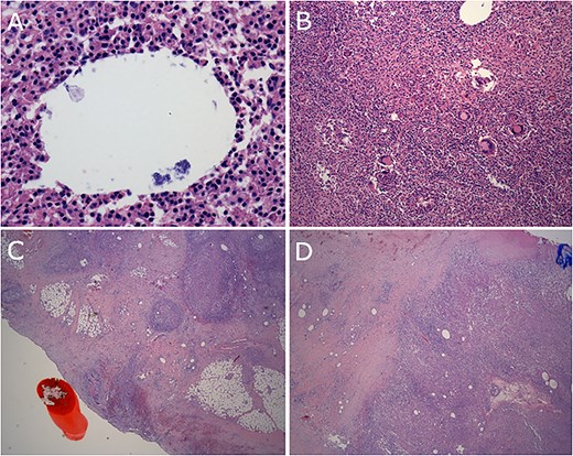 (A) Bacterial organisms within vacuole. (B) Granulomas and giant cells. (C) Reaction involving serosal surface of colon. (D) Reaction involving diaphragm.