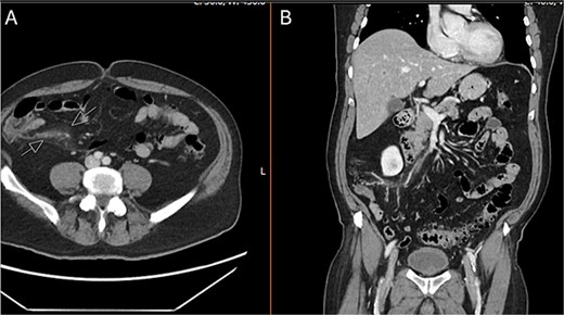 CT abdomen and pelvis with IV contrast. A) Axial and B) coronal series identifying normal appendix and right lower quadrant mesenteric inflammatory changes.