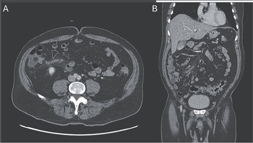 CTA abdomen and pelvis venous phase. A) Axial and B) coronal series revealing filling defect within the ileocolic vein with surrounding inflammatory changes, consistent with mesenteric thrombophlebitis of the ileocolic vein.