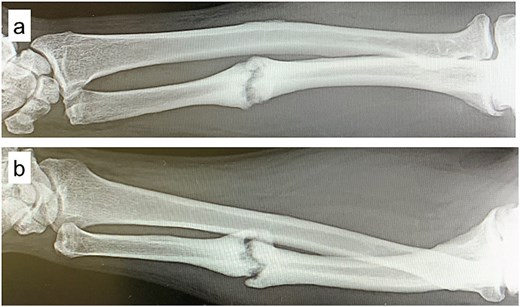 Plain radiographs at initial presentation. (a, b) Nonunion at the mid-diaphysis of the ulna is observed.