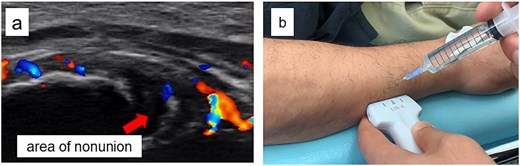 Ultrasound findings and images during the procedure. (a) Ultrasound image at the start of treatment showing marked Doppler signals around the nonunion site. (b) Dextrose injection into the nonunion site under ultrasound guidance.