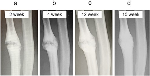 Radiographic findings during follow-up. (a) At 2 weeks, early callus formation is observed. (b) At 4 weeks, increased callus formation is noted. (c) At 12 weeks, near complete union is evident. (d) At 15 weeks, complete union achieved.