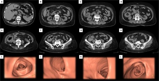 Abdominal CT and 3D colonoscopy. Images A–H depict the descending sequence of axial CT slices, with the white arrow indicating the lesion at the colonic level. Images I–L correspond to selected views from a virtual colonoscopy: Image I shows the transverse colon, J the hepatic flexure, K the ascending colon and cecum, and L highlights the lesion located in the cecum.