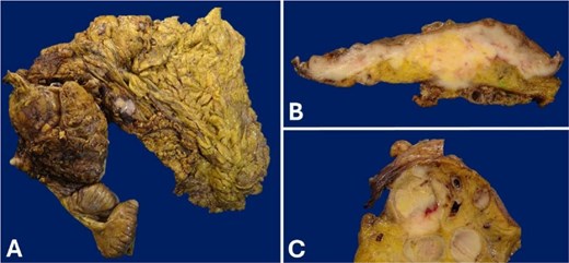 Gross appearance of the cecum wall. (A) Product of right hemicolectomy. (B) The tumor that infiltrates the full thickness of the cecal wall. The lesion involves the mucosa, which is ulcerated. (C) Conglomerate of lymph nodes.