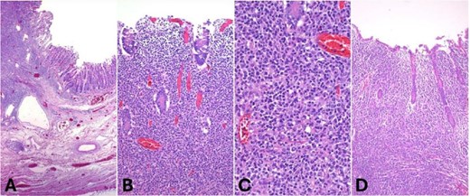 Hematoxylin and eosin (H&E) staining. (A) Low-power view showing diffuse infiltration of the intestinal wall by a dense lymphoid neoplasm (40×, H&E). (B) The tumor extensively involves the mucosa (100×, H&E). (C) High power view showing large atypical lymphoid cells with irregular round nuclei and dispersed chromatin (400×, H&E). (D) Appendiceal wall infiltrated by the neoplasm.