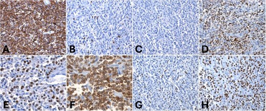 Immunohistochemistry. (A) Diffuse and strong CD20 positivity in tumor cells, (B, C) negative CD5 and CD10 in neoplastic cells but positive MUM1 and BCL6 for tumor cells (D, E). Strong BCL2 and c-MYC positivity in 10% of tumor cells (F, G). (H) Ki67 proliferation index: 70%.