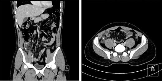 CT scan showing an inflamed, dilated appendix with surrounding fat stranding and intraluminal calcifications in (A) coronal and (B) axial views.