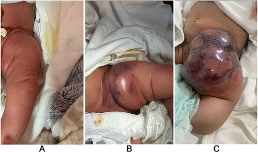 Case #1 lesion progression: (A) at birth, (B) 3 weeks prior to presentation, (C) upon presentation.