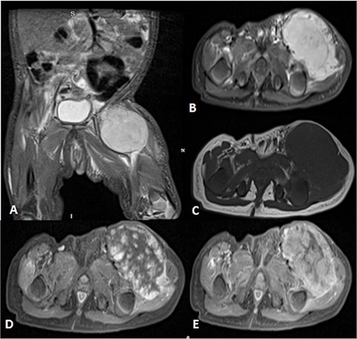 Uploaded MRIs of the left inguinal mass. (A and B) Coronal and axial short tau inversion recovery (STIR) images show a well-defined large heterogeneously high signal intensity with an area of signal void arising from the left upper thigh quadriceps muscles region. (C) Axial T1WI shows that mass appear isointense in signal intensity in correlation to the muscle signal with no intralesional hemorrhagic component. (D and E) Axial T1 fat-saturated images’ early and delayed phases show peripheral discontinuous nodular enhancement with subsequent centripetal enhancement on the delayed phase. The aforementioned MR findings are typical for hemangiomas.
