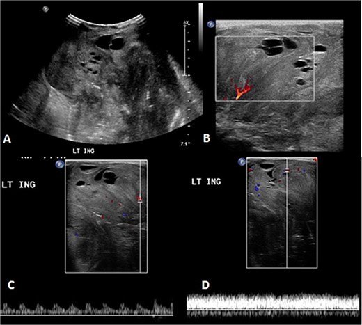 The follow-up ultrasound 3 weeks after MRI. (A) The gray scale image demonstrates a large heterogeneous predominantly isoechoic mass seen at the left inguinal region with multiple scattered areas of cystic changes and difficult-to-assess extent due to its size. (B–D) Color Doppler and spectral wave images show vascularity within the mass with detectable arterial and venous waveform.