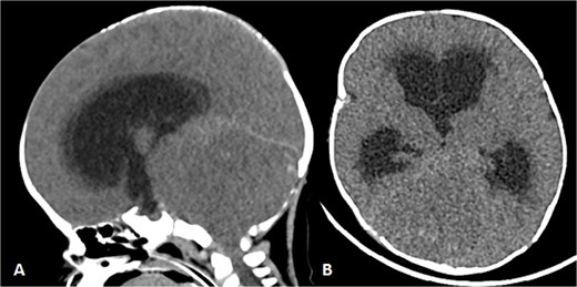 Patient underwent brain CT after presenting to the ER due to seizure. (A and B) Sagittal and axial nonenhanced brain CT shows an isodense mass in the posterior cranial fossa with scattered areas of hyperdense foci denoting a hemorrhagic component that is completely effacing the fourth ventricle, causing supratentorial ventricular dilatation and periventricular hypodensity denoting cerebrospinal fluid (CSF) permeation indicating an active obstructive hydrocephalus. Also noted bilateral tonsillar herniation.