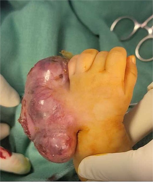 Lesion size 4 × 2 cm.