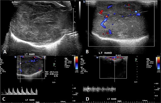 Initial imaging utilizing gray scale and color Doppler US. (A) A gray scale US image showing a large heterogeneous lesion predominantly hyperechogenic in echotexture with a partially defined margin and (B–D) color Doppler US and spectral waveform showing internal vascularity within the lesion with the presence of arterial and venous waveform. The aforementioned findings are atypical for hemangiomas.
