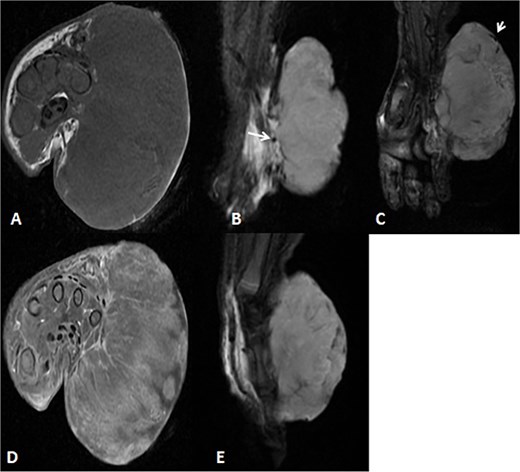 MRI of left hand mass. (A) Axial T1WI shows a huge homogenous isointense mass to the corresponding hand muscles signal intensity, which is seen along the medial aspect of left hand. (B and C) Coronal STIR demonstrate heterogeneous diffuse high signal intensity of the lesion and appears inseparable with sign of invasion to the fourth and fifth digits extensor compartment/tendons as well as presence of areas of signal void (arrow). (D and E) Axial and sagittal post-contrast T1 fat-saturated images show diffuse progressive intense enhancement of the lesion.