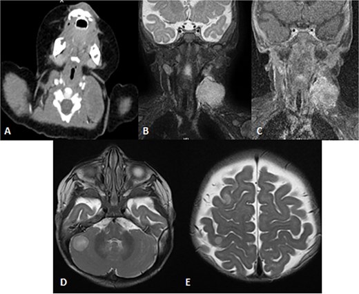 Patient underwent brain and neck MRI after incidental findings of left neck mass on chest CT. (A) Axial enhanced chest CT and the imaged part of the neck show a large heterogeneously enhanced left neck mass mostly arising from the left sternocleomastoid muscle with central necrosis causing mild mass effect upon left internal jugular vein with no sign of invasion or thrombosis. (B and C) Coronal STIR and postcontrast T1 fat-saturated images show homogenously high signal of the left neck mass arising from the left sternocleomastoid muscle on the STIR image with heterogeneous enhancement and central necrosis on the postcontrast image. (D and E) Axial T2WI images show multiple scattered, rounded high-signal-intensity supra- and infratentorial lesions at the gray–white matter junctions involving right frontoparietal lobes and the right cerebellar hemisphere, in keeping with brain metastasis.