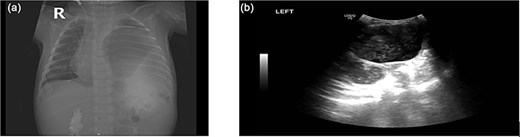 (a) Opacified left hemithorax with shifting of the mediastinum to the right side due to possible left diaphragmatic hernia also there is right perihilar infiltrate. (b) US showed: Large cystic structure noted in the left side of chest likely stomach, diaphragmatic hernia cannot be ruled out.