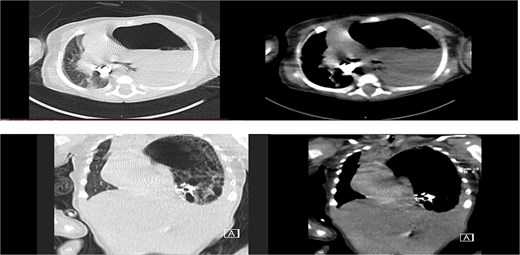 Axial, coronal CT chest revealed: Left diaphragmatic hernia (Bochdalek hernia) stomach herniation to the left hemithorax with a shift in the mediastinum.