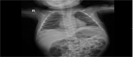 Post-op chest X-ray was normal and show a full expansion of the left lung, with normal diaphragm, normal stomach gas in the intraperitoneal region.