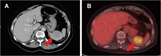 Splenic metastasis. Contrast-enhanced CT (A) and positron emission tomography-CT (B) demonstrate a solitary 2-cm splenic mass (arrows).