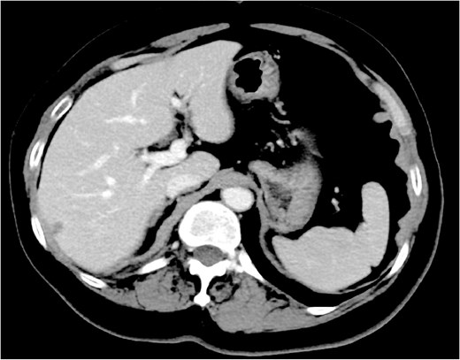 Effect of chemotherapy plus anti-HER2 therapy on splenic metastasis. Contrast-enhanced CT following six cycles of docetaxel, trastuzumab, and pertuzumab shows complete resolution of the splenic lesion.