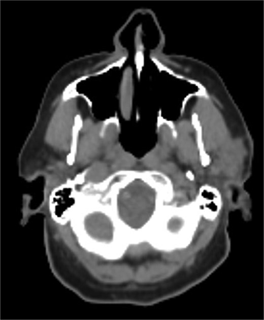 Hypermetabolic mass in the superficial anterior left parotid gland measuring 2.8 × 2.5 × 2.6 cm.