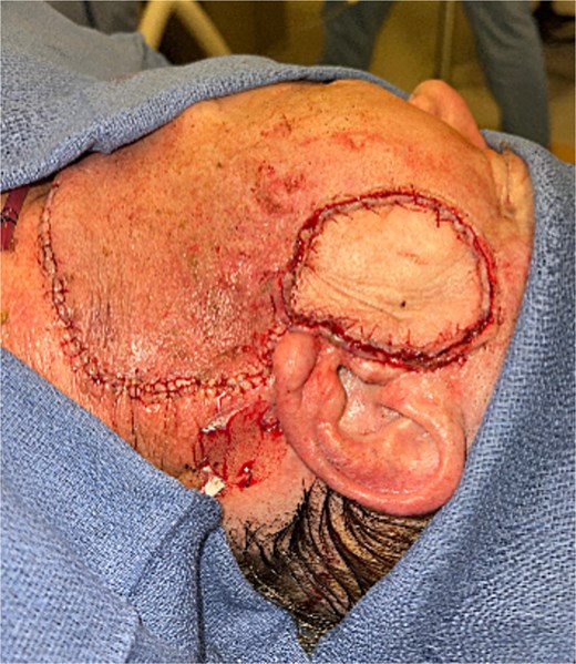 Parotid mass.