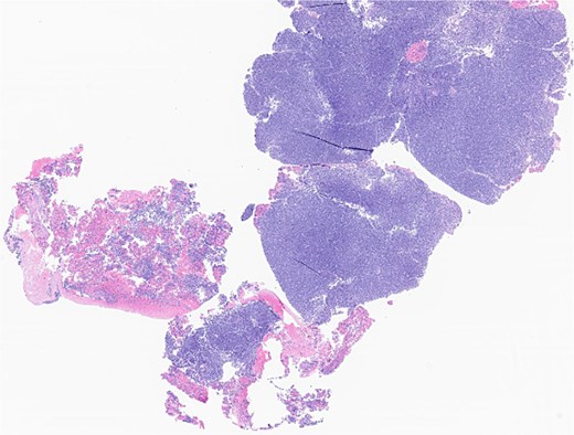 Left parotid tumor, biopsy: small lymphocytic lymphoma/CLL involving a lymph node.