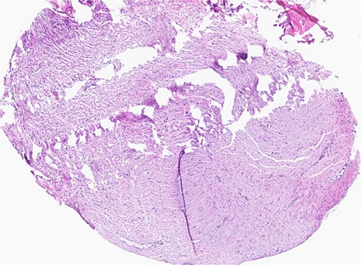 Facial nerve, left, proximal margin, biopsy: focally involved by invasive SCC.