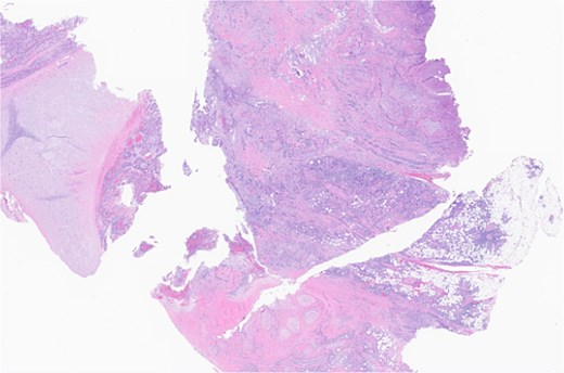 Ear, left, auriculectomy: invasive moderately differentiated SCC, forming a poorly demarcated infiltrating dominant mass, ~5.5 cm in size and 2 cm in depth of invasion; extensive nerve invasion and focal lymphovascular invasion.