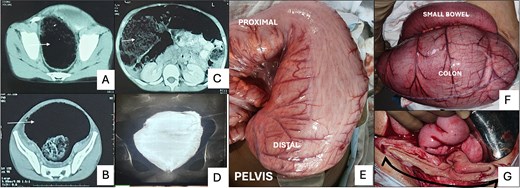 (A) and (B) show a grossly dilated colon (white arrow) in the pelvis at the level of the pelvic brim and ischial spines. (C) Cross-sectional image on CT showing air and stool-filled colon (white arrow) displacing the small bowel loops to one side. (D) Contrast enema after 3 months of Hartmann’s procedure, demonstrating persistent dilatation of the rectal stump. (E) Intra-operative picture of Case 1 displays a severely dilated colon extending beyond the peritoneal reflection, lacking features typical of a pouch colon. (F) Intra-operative image of Case 2 showing gross dilatation of the colon in comparison to the small bowel. (G) Illustrates the sizeable luminal caliber of the distal stump (black arrow) after resection at the peritoneal reflection.