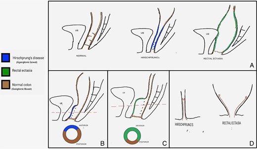 Shows a schematic diagram of various pathologies before and after the surgical procedure. (A) Compares the gross anatomy of a normal colon with that of HD and rectal ectasia. (B) and (C) Show a post-Duhamel pull-through cross-section in HD that illustrates the ratio of aganglionic bowel to normal colon and ectatic bowel to normal colon in rectal ectasia, respectively. (D) Provides an image depicting the direction of dissection for the soave pull-through in HD compared to rectal ectasia.