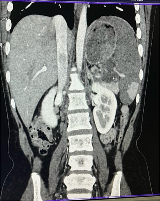 Contrast enhanced computer tomography (CECT) abdomen showing necrotic lymph node mass near pancreatic tail and splenic hilum.