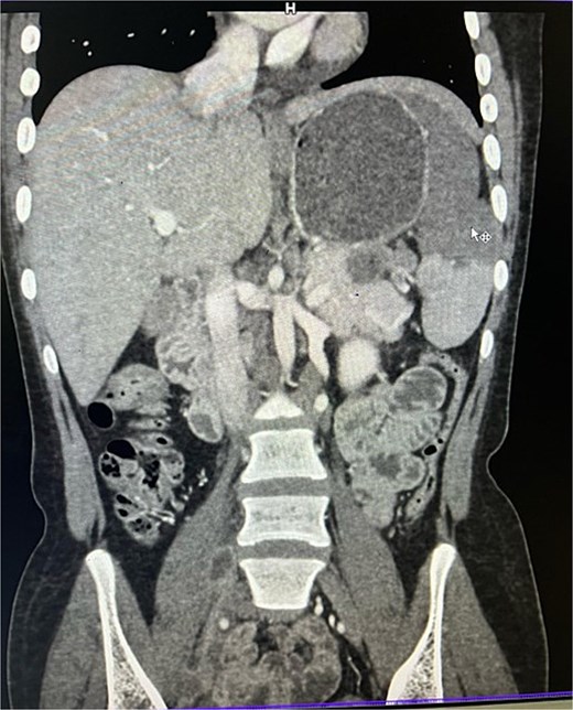 CECT abdomen showing splenic infarct involving significant portion of splenic parenchyma—except at the lower pole of spleen.